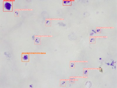 Desarrollo de un sistema de diagnóstico automatizado por la malaria y la esquistosomiasis urogenital utilizando herramientas de inteligencia artificial y un microscopio robotizado universal de bajo coste